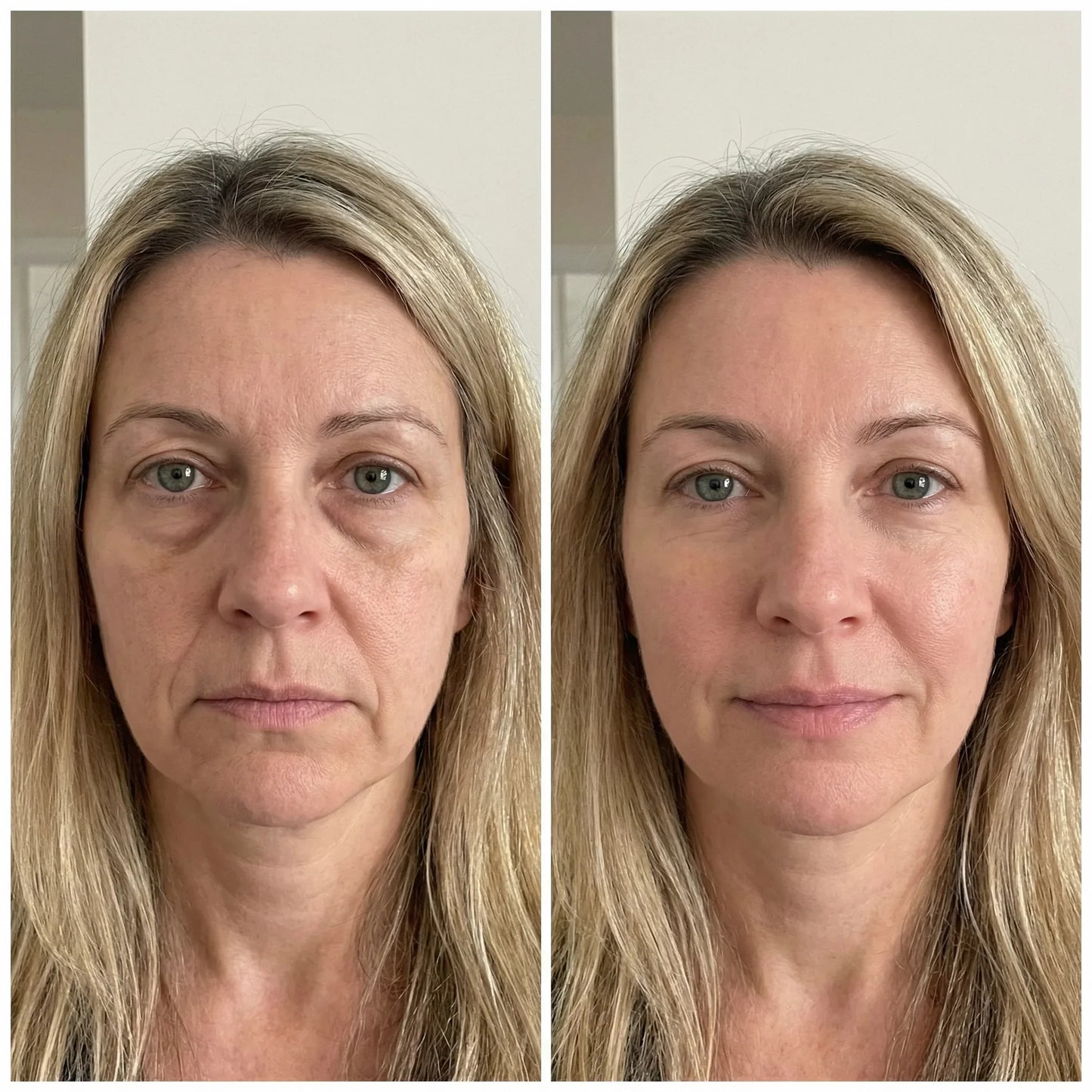 Cepillo de Masaje Linfático Facial Smartzen